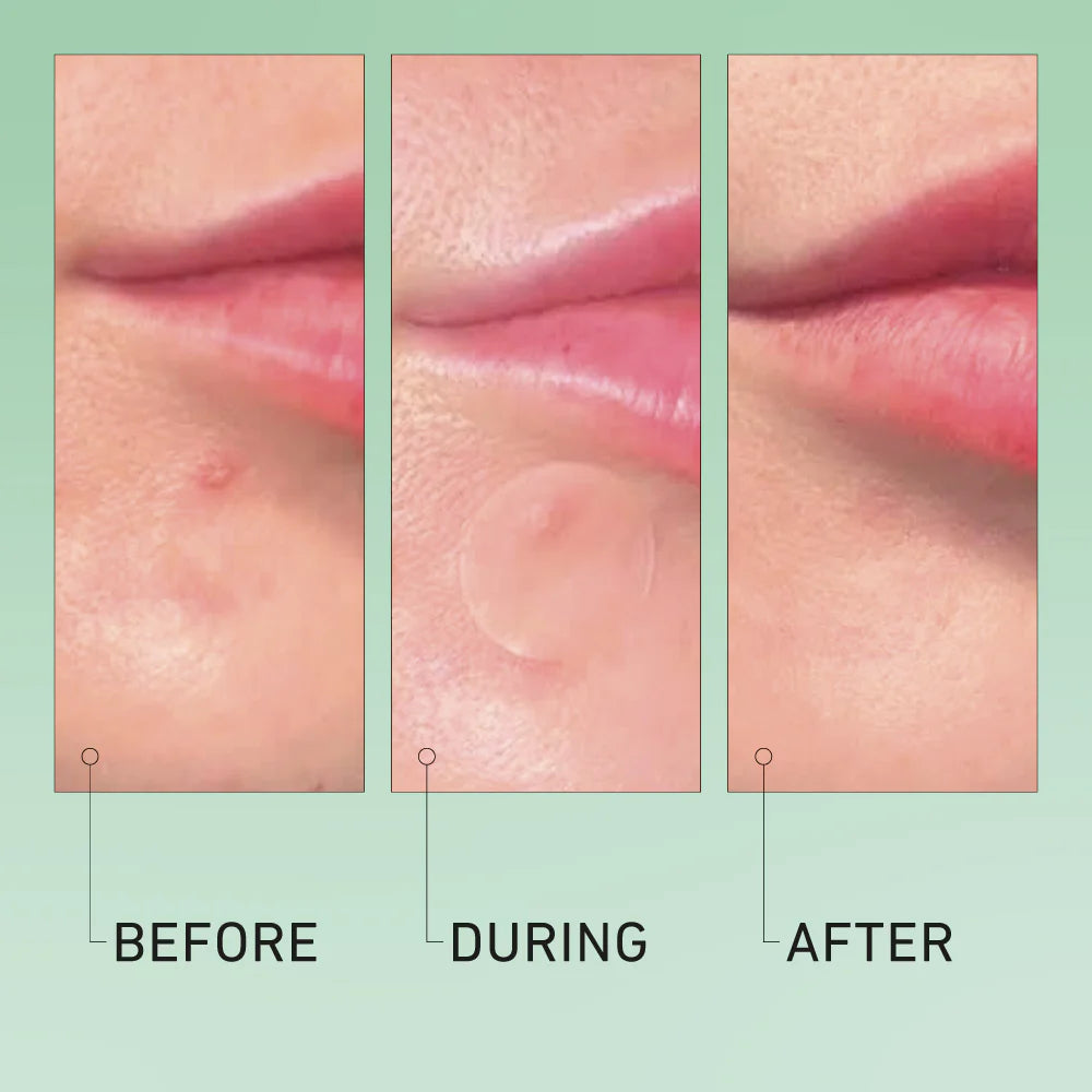 ZapNose Pimple Patches - Invisible Hydrocolloid Acne Patches